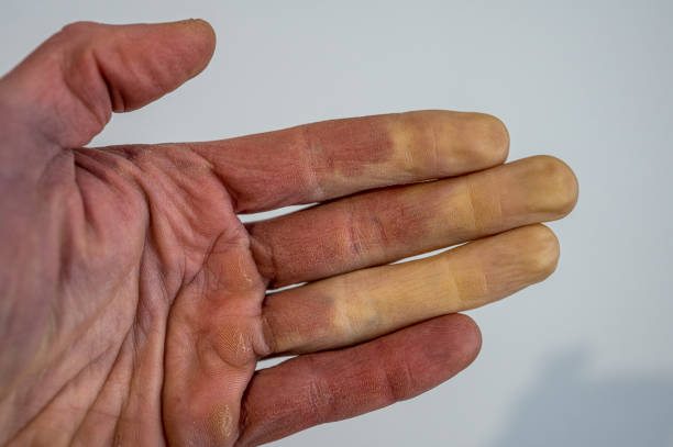 Illustration des changements de couleur des doigts affectés par la maladie de Raynaud.
